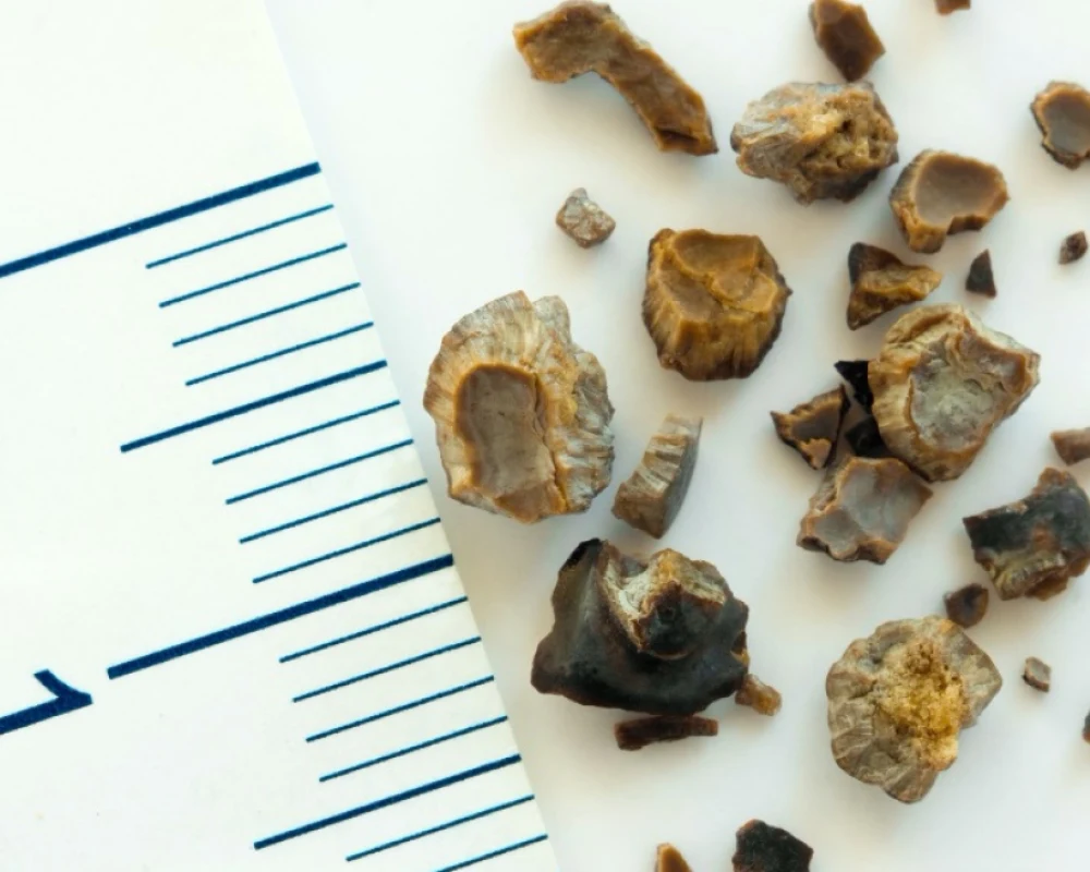 علاج ثوري قد يُنهي عذاب حصوات الكلى