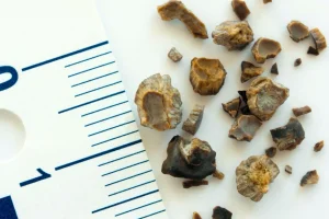 علاج ثوري قد يُنهي عذاب حصوات الكلى